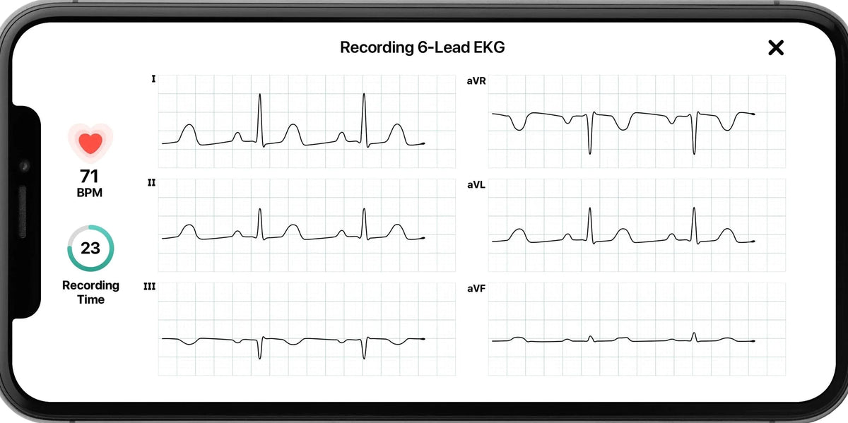 AliveCor KardiaMobile 6L Personal EKG Monitor, Black - KM-6L-E